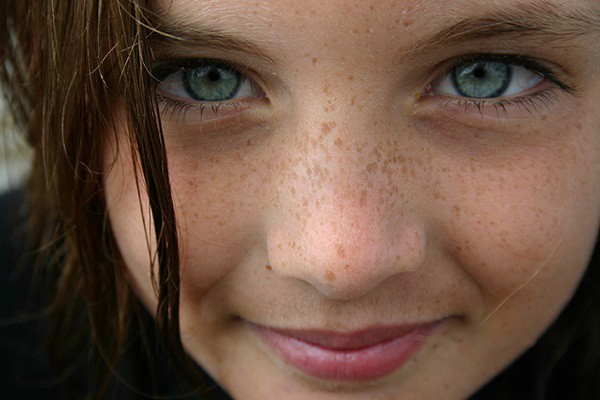 Best Natural Remedy For Freckles On Face