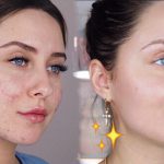 How to remove dark spots from face fast