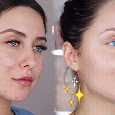 How to remove dark spots from face fast