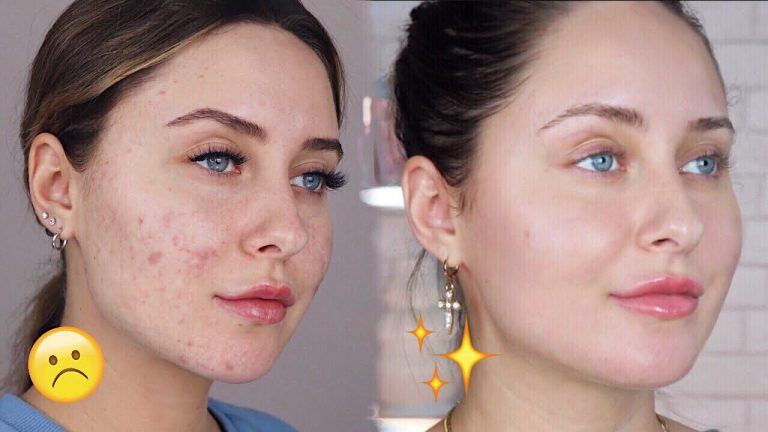 How to remove dark spots from face fast