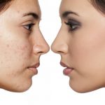 Dark Spots Home Remedies