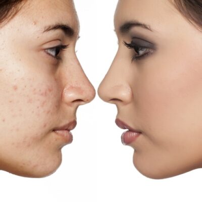 Dark Spots Home Remedies