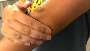 Best Home remedies for dark elbows and knees