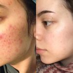 How To Get Rid Of Pimples Naturally At Home For Oily Skin