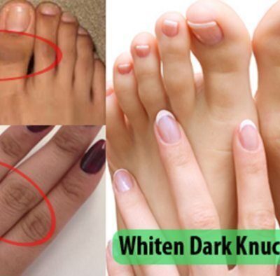 How to remove dark knuckles in one week