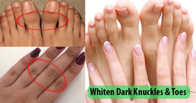 How to remove dark knuckles in one week