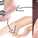 how to fix cracked heels permanently at home