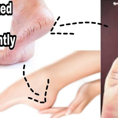 how to fix cracked heels permanently at home