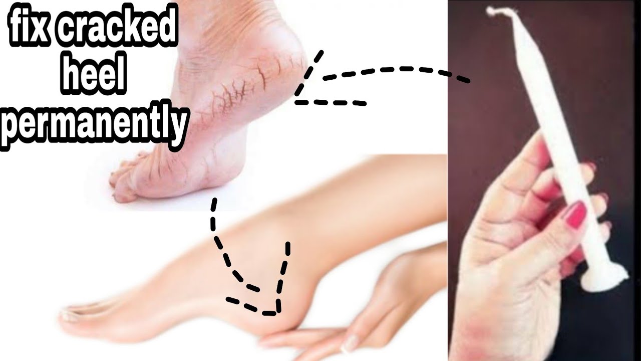 how to fix cracked heels permanently at home