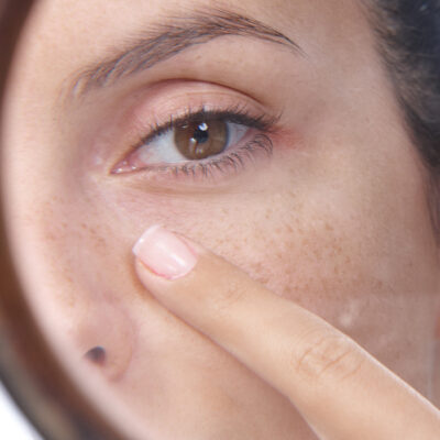 how to get rid of blemishes and acne scars