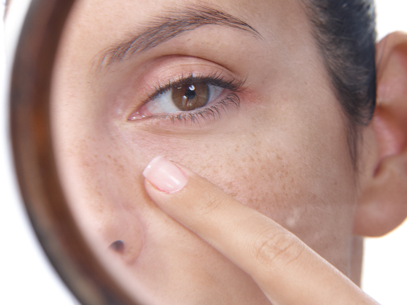 how to get rid of blemishes and acne scars