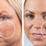 Home Remedies For Acne Scars On face