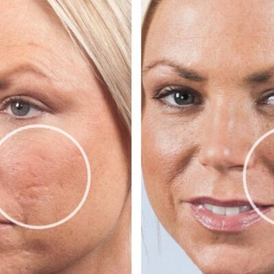 Home Remedies For Acne Scars On face