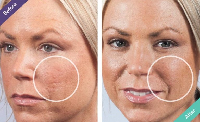 Home Remedies For Acne Scars On face