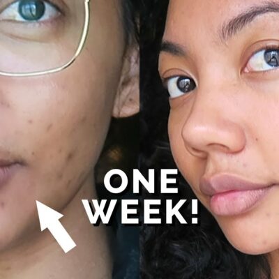 How-to-Remove-Dark-Spots-From-Face