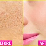 How To Get Rid Of Open Pores Permanently