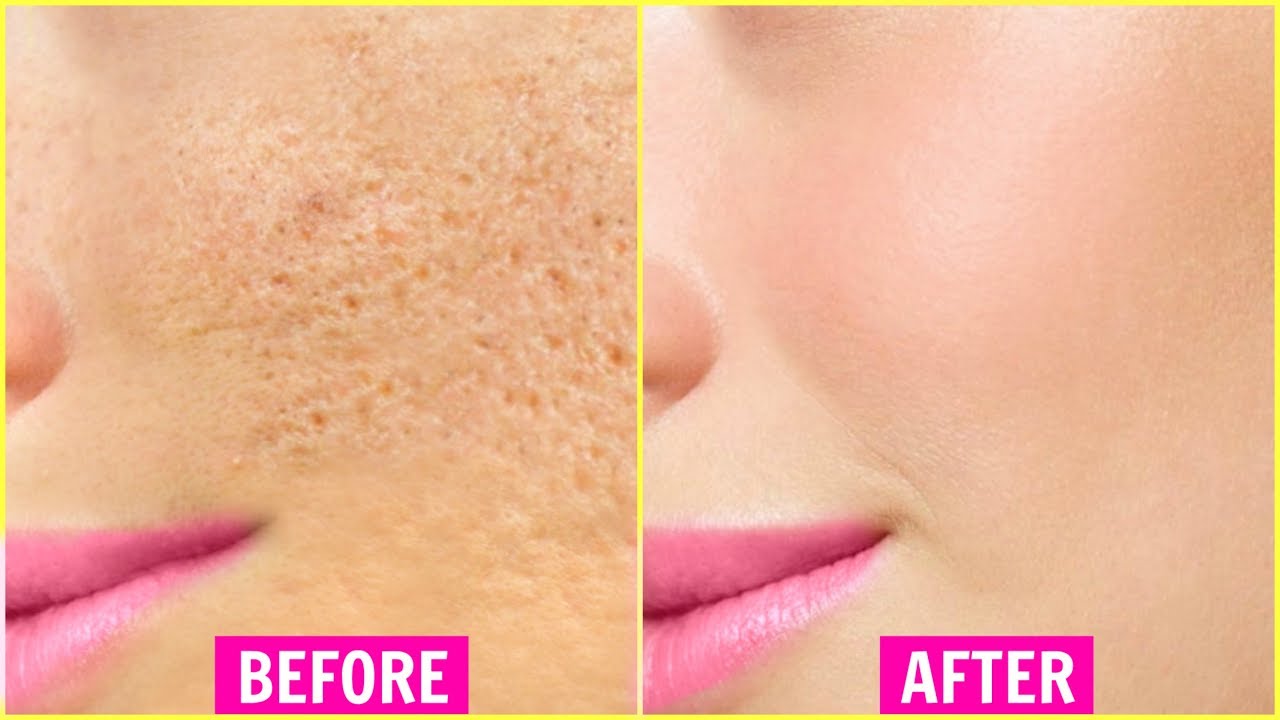 How To Get Rid Of Open Pores Permanently