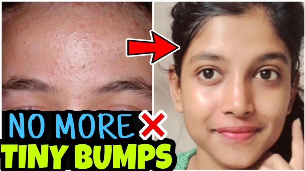 How To Get Rid Of Tiny Bumps On Face Quickly Naturally