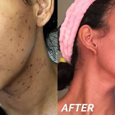 How To Remove Black Spots On Face Naturally (1)
