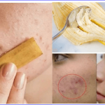 Amazing Benefits Of Banana Peel For The Skin
