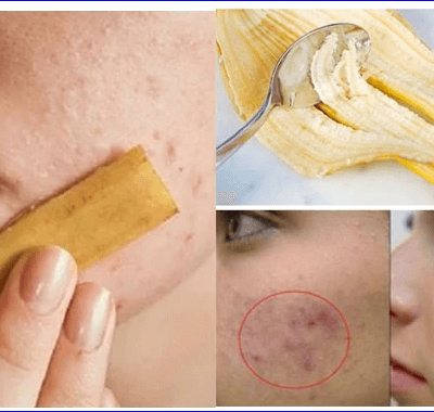 Amazing Benefits Of Banana Peel For The Skin