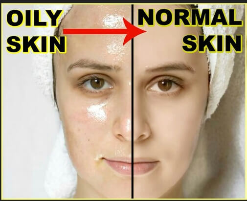 natural skin care routine for oily acne prone skin