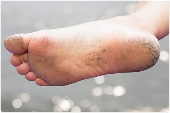 uses of castor oil for feet
