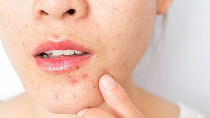 castor oil to treat acne