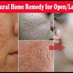 Get rid of open pores naturally