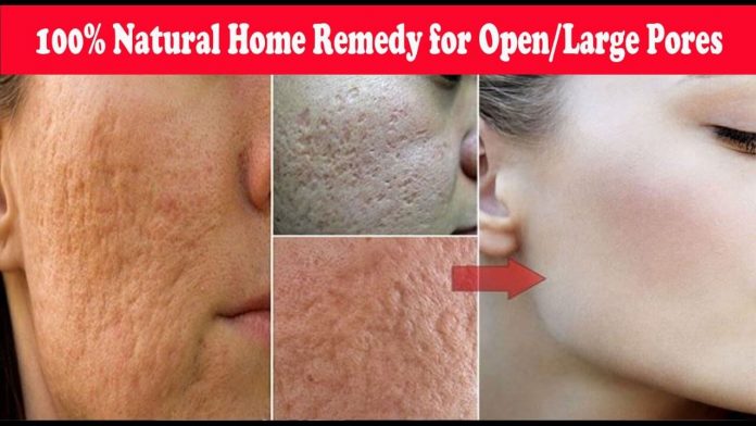 Get rid of open pores naturally