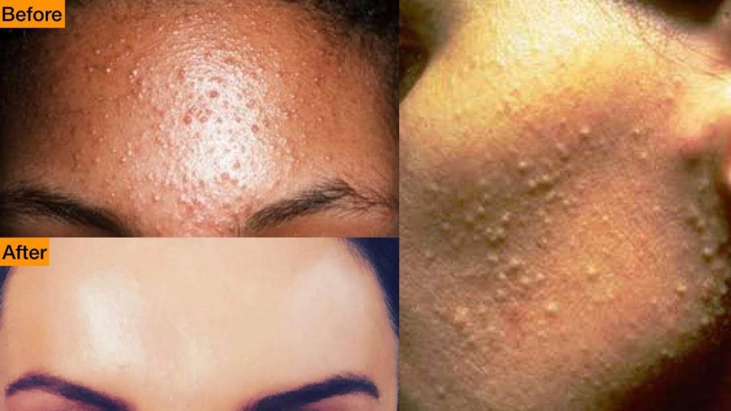 dyshidrotic-eczema-small-bumps-on-hands-recipes-and-beauty-tips