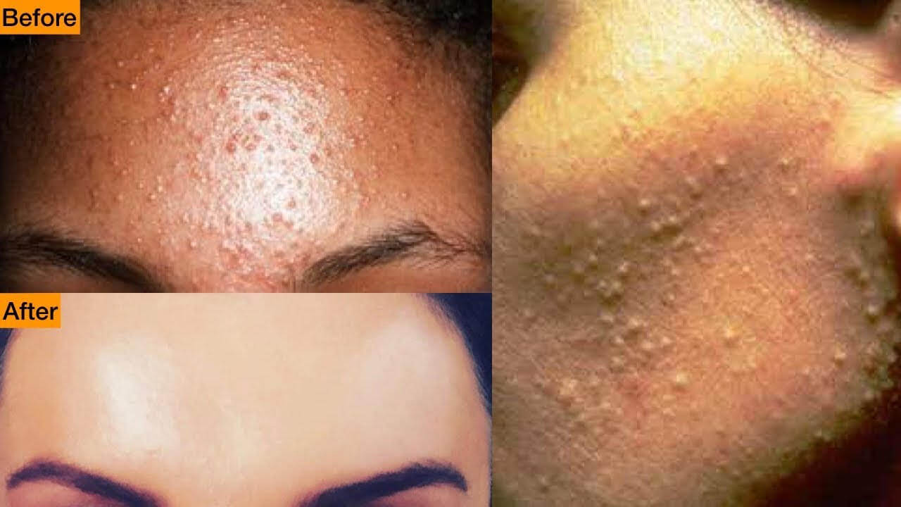 Small Bumps Milia On Face Causes Prevention And Treatment