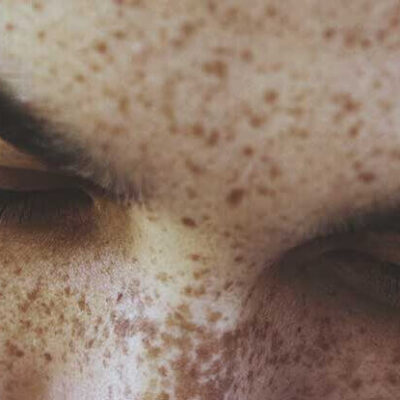 tiny black dots on the skin
