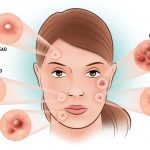 Types of acne, causes and prevention
