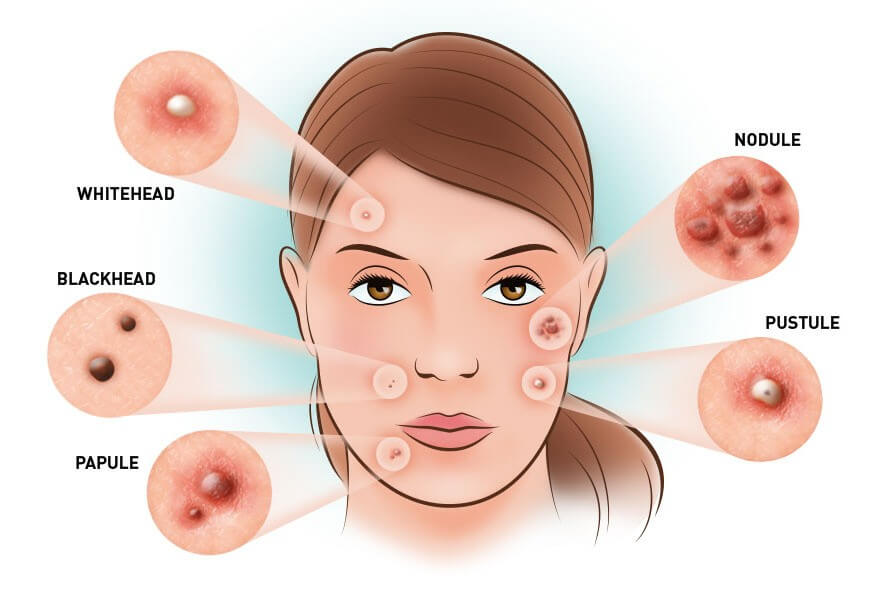 Types of acne, causes and prevention