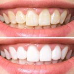 how to make white teeth naturally from yellow