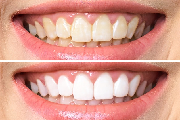 how to make white teeth naturally from yellow