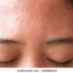 how to get rid of small bumps on forehead