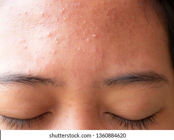 how to get rid of small bumps on forehead