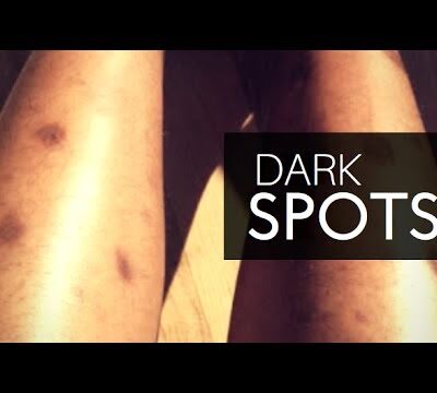 brown spots on legs