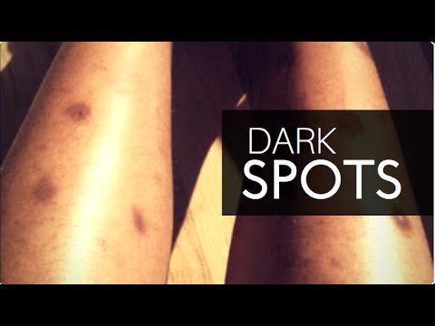 brown spots on legs