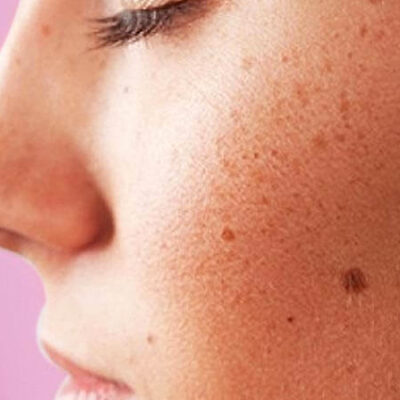Home remedies to get rid of black spots
