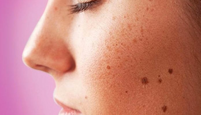 Home remedies to get rid of black spots
