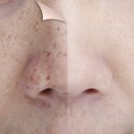 Homemade soap for black spots on skin
