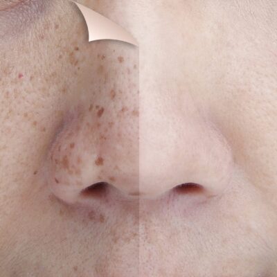 Homemade soap for black spots on skin