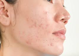 how to know Acne-prone skin type