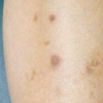 Black spots on legs