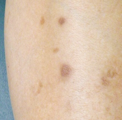 Black spots on legs