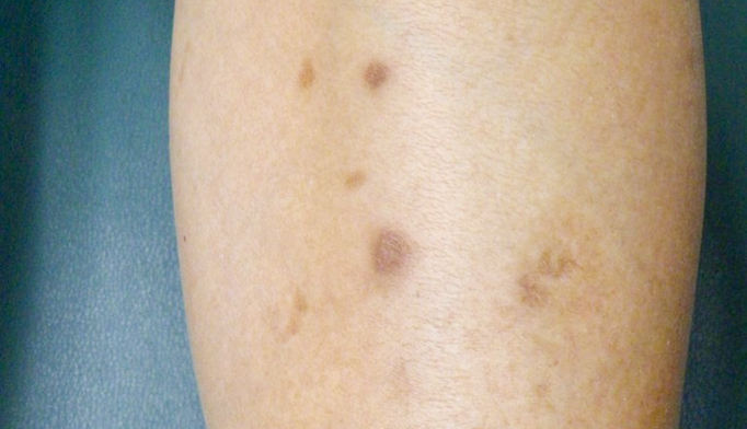 Black Spots On Legs 