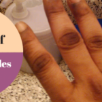 Dark knuckles: Causes and home remedies